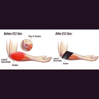 Elbow Compression Sleeve For Bursitis (ES3) - Black